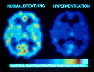 Normal breathing vs hyperventilation brain image